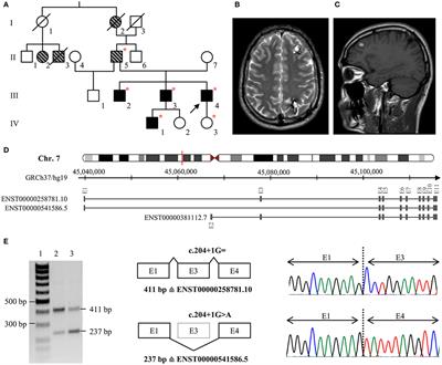 Novel Pathogenic Variants in a Cassette Exon of CCM2 in Patients With Cerebral Cavernous Malformations